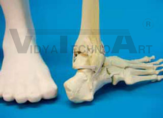 Foot 4-part, malunion, foam coat 90°